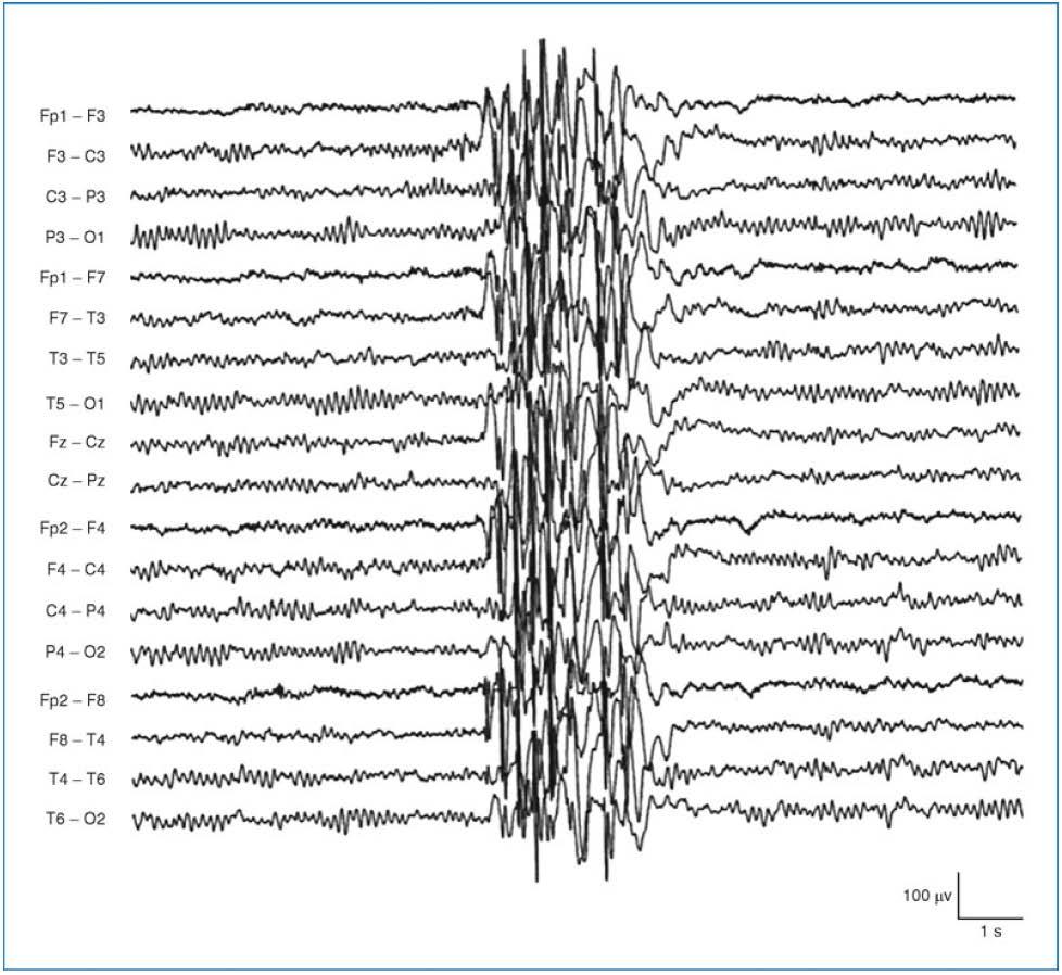 Ασθενής 7 ετών με αφαιρέσεις: Τυπική εκφόρτιση 3 Hz αιχμή-κύμα με πρόσθια επικράτηση.