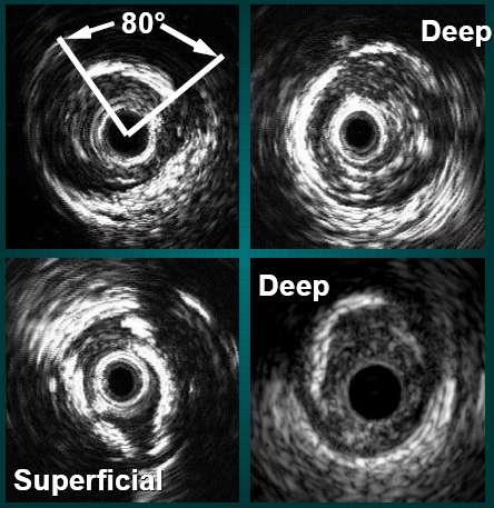 IVUS: εκηίμηζη ζύζηαζηρ πλάκαρ Αζβεζηυμένη πλάκα Φαίνεηαι ένηονα λεςκό και «λαμπεπό»