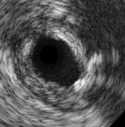 IVUS: εκηίμηζη ζύζηαζηρ