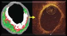 lesions IVUS-derived