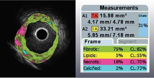 to VH- IVUS with 20-MHz solid-state IVUS system).