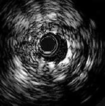 Effect of underexpansion (inadequate stent