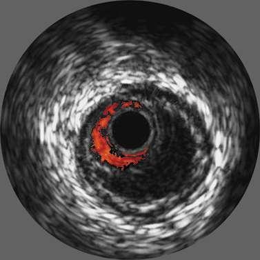 IVUS: