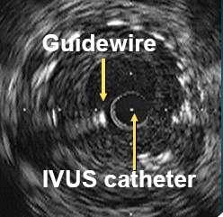 IVUS image: measurements Artery with a stent Stent CSA Intimal