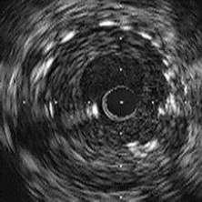 IVUS image: in-stent restenosis