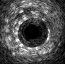 hyperplasia) (IH) often appears