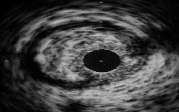 IVUS: εκηίμηζη ζύζηαζηρ πλάκαρ Μαλακή πλάκα: σαμηλή ησογένεια (ςτηλή