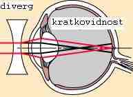 Kratkovidnost se popravlja pooćo divergentne leće (negativna žarišna udaljenost) koja zrake svjetlosti raširi prije nego dođu do oka.