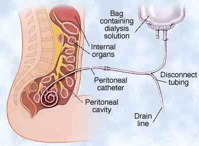 Αρχές Περιτοναϊκής Κάθαρσης Peritoneal