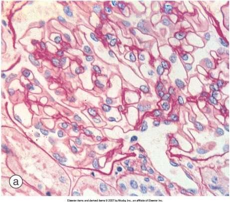 Pathologic lesions of Diabetic Nephropathy Light microscopy of structural changes in diabetic nephropathy.