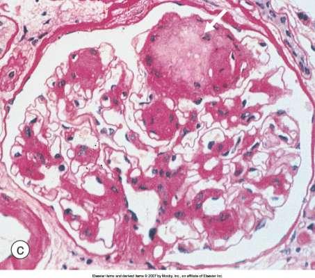 Pathologic lesions of Diabetic Nephropathy Light microscopy of structural changes in diabetic nephropathy.