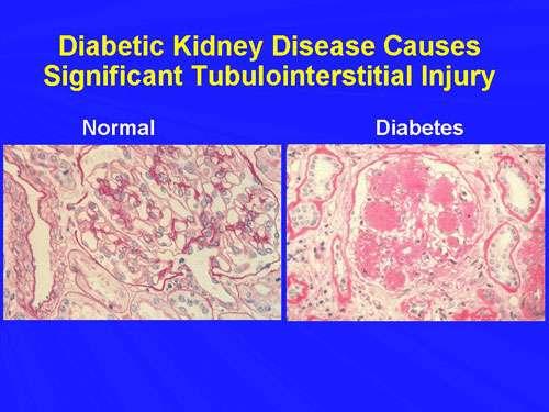 Tubulointerstitial changes in diabetes: thickened basement membrane, matrix increase (a lot of stuff, cells, and fibrous material