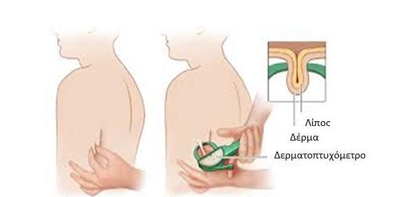 Μέτρηση δερματικών πτυχών σε: Α)