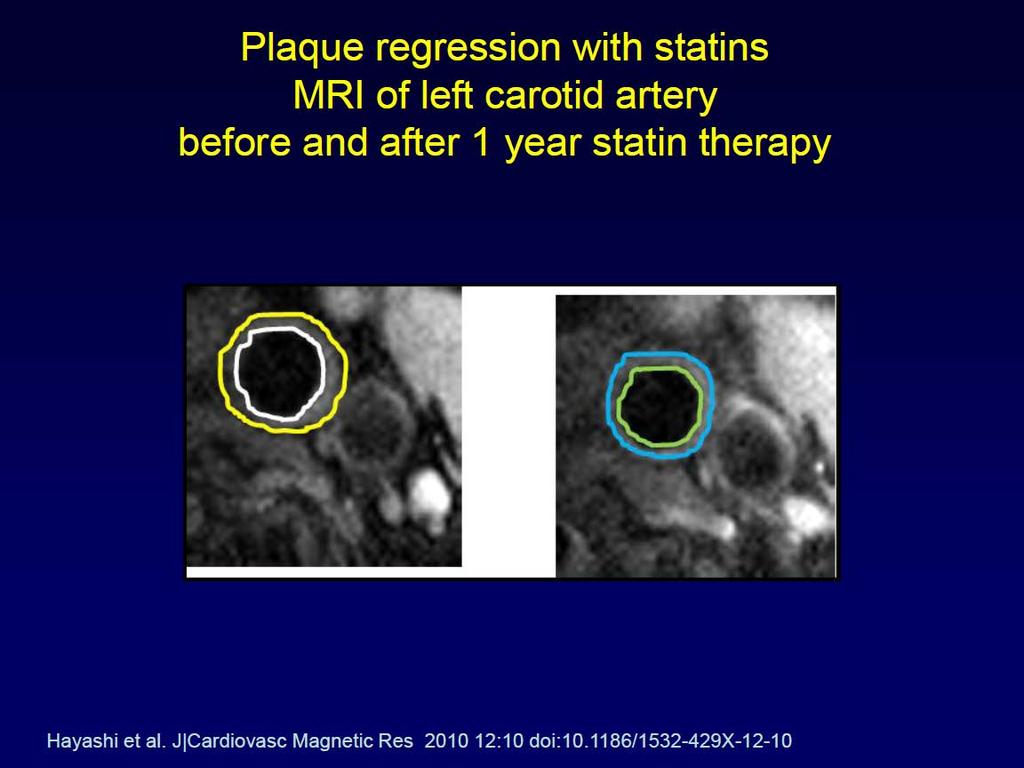 Υποστροφή πλάκας μετά από θεραπεία με στατίνες MRI