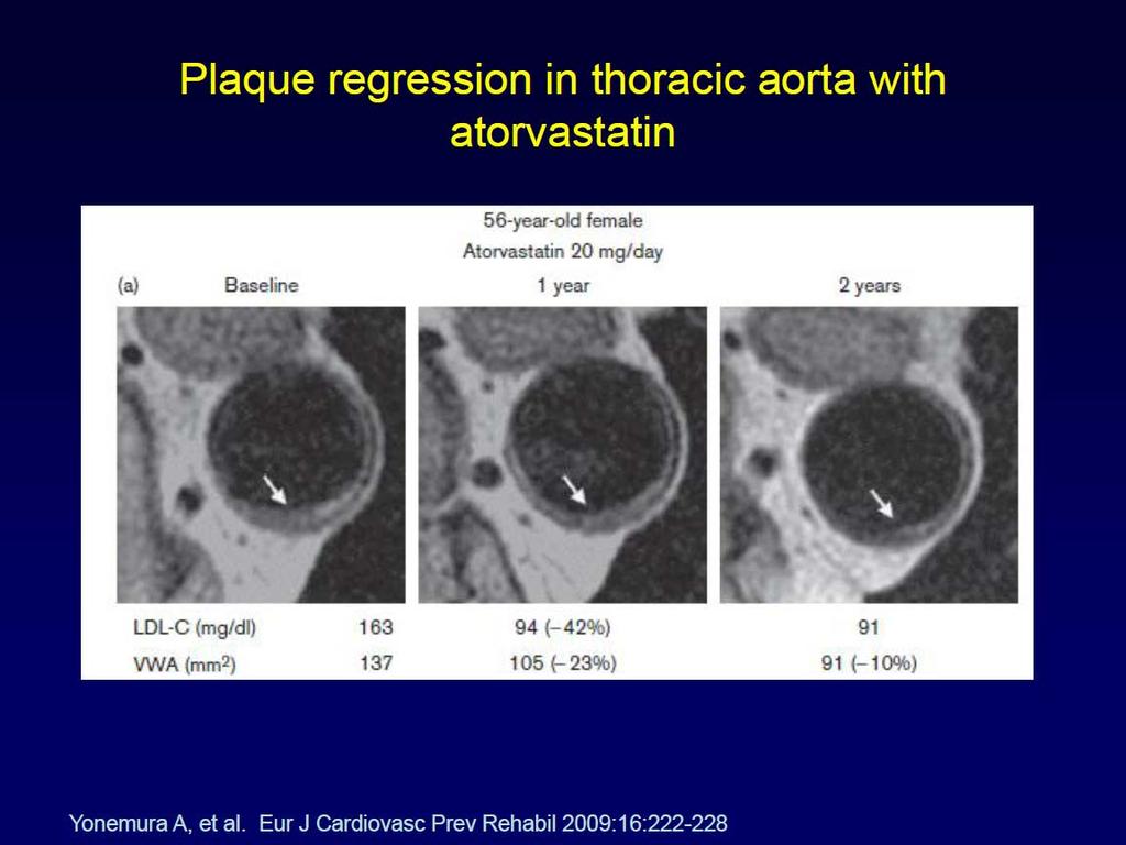 Μελετήσανε τη μακροπρόθεσμη επίδραση των20 έναντι των 5mg ατροβαστατίνης στις θωρακικές και κοιλιακές πλάκες και τη σχέση μεταξύ της εξέλιξης της πλάκας και τα επίπεδα της LDL χοληστερόλης υπό