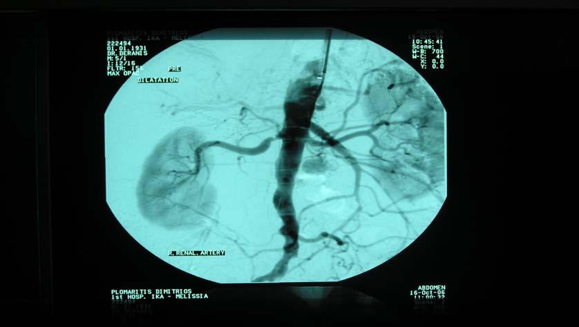 Renal Artery Stenosis The incidence of renal artery stenosis (RAS) among pts undergoing cardiac catheterization varies between 20% ~ 30% and in 15% of them is severe (>50%) Harding MB, J Am Soc