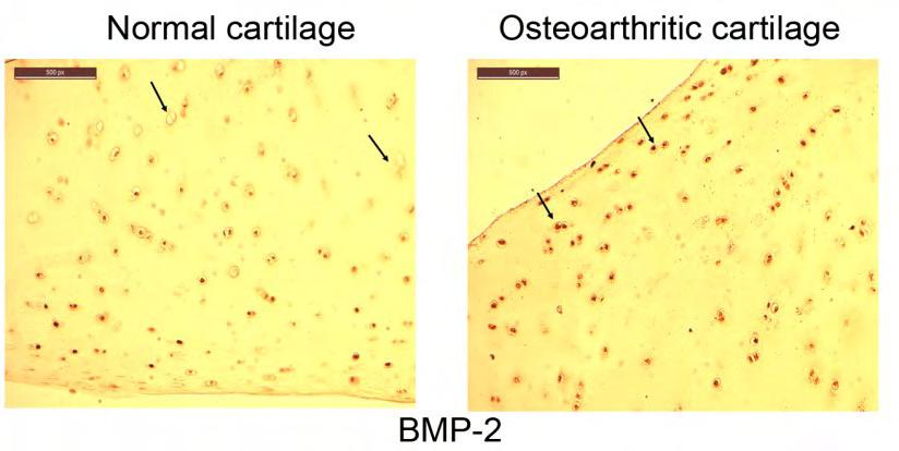 ΟΑ χονδροκυττάρων. (γ) Ποσοτική απεικόνιση των πρωτεϊνικών επιπέδων των γονιδίων BMP-2, BMP-4, και BMPR-IA σε καλλιέργειες φυσιολογικών και ΟΑ χονδροκυττάρων. *p<0.05.