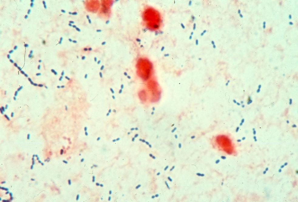 Slika 2. Izgled ćelija Streptococcus pneumoniae u direktnom preparatu likvora, obojenom po Gramu; uočavaju se izdužene diplokoke, koje mogu formirati lance 2.