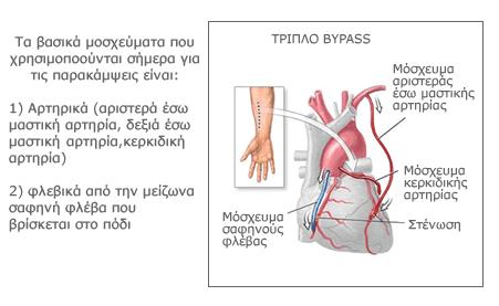 Κεντρική στένωση του πρόσθιου κατιόντα κλάδου της ΑΣΑ Ασταθής στηθάγχη και νόσος 2 ή 3 αγγείων και χαµηλό κλάσµα εξώθησης της αριστεράς κοιλίας Νόσος 2 ή 3 αγγείων µε συνοδό στηθάγχη ανθεκτική στη