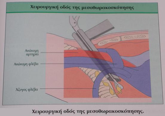 Μεσοθωρακοσκόπηση Γοαηζζεζία: 81% θαη Γηδηθόηεηα: