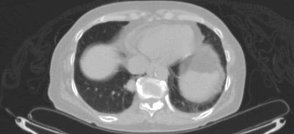 Case 76-year-old never smoker with cough