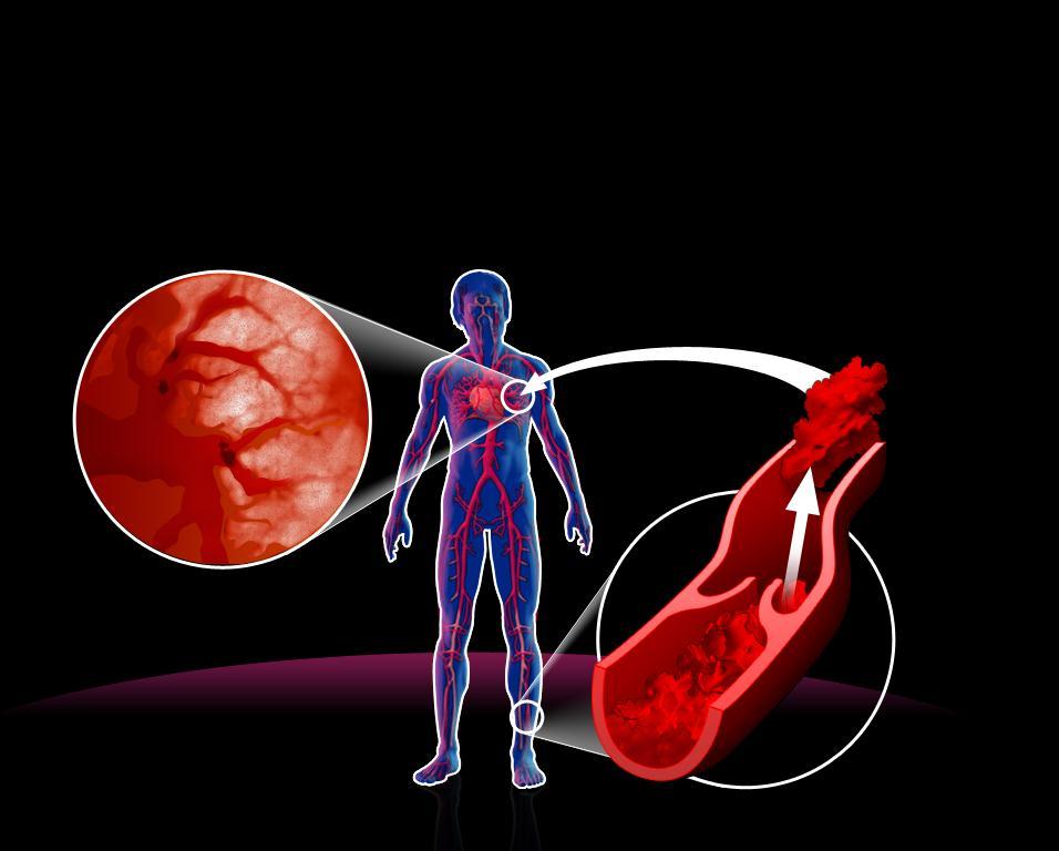 VTE: deep vein thrombosis and pulmonary embolism Pulmonary embolism PE occurs when parts of the clot detach and travel