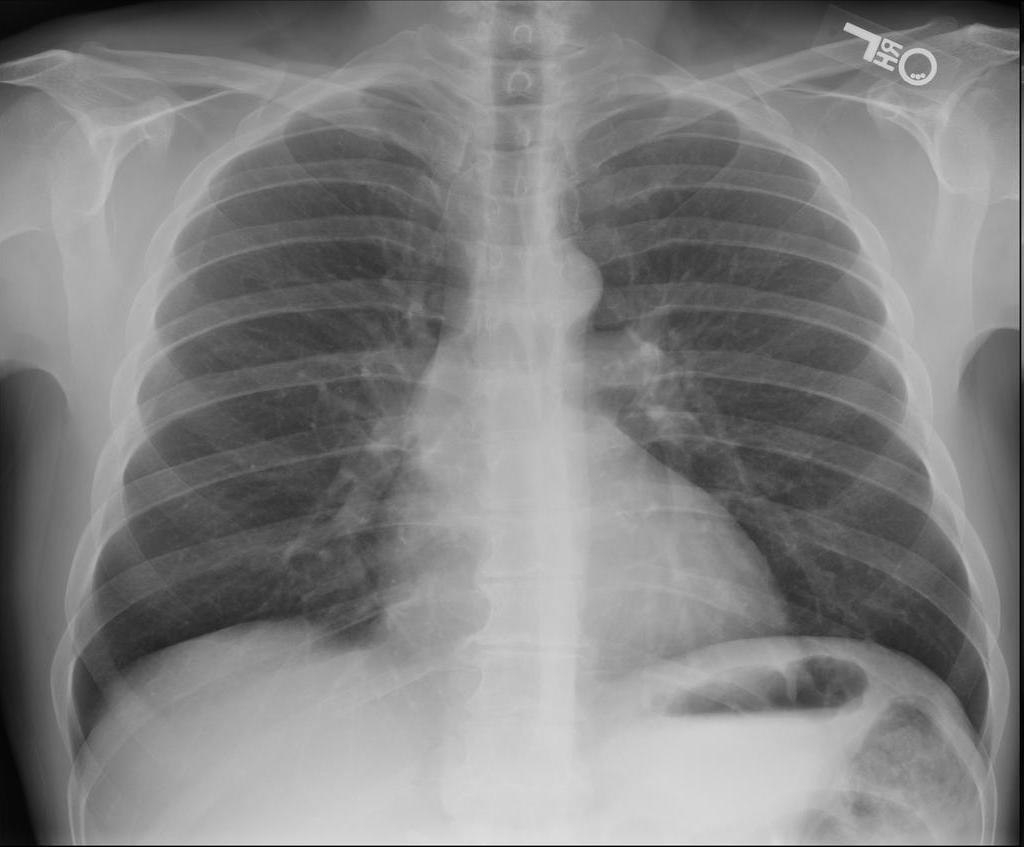 Prior CXR