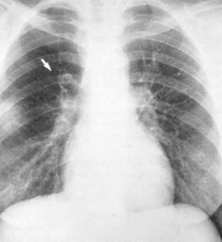 Westermark sign Dilatation of pulmonary vessels proximal to