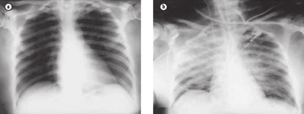 Εικόνα 1. (a) Φυσιολογική ακτινογραφία θώρακος ασθενούς. (b) Ακτινογραφία θώρακος του ίδιου ασθενούς όταν μετά μετάγγιση FFP εμφάνισε σοβαρό TRALI.