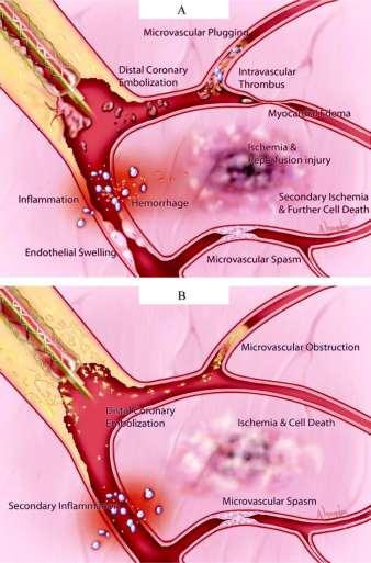 Figure 2. A, Schematic representation of pathophysiological mechanisms that may contribute to reperfusion no reflow in the setting of primary angioplasty for AMI.