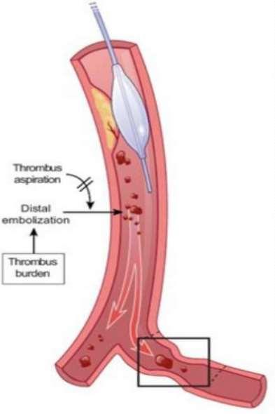 Περιφερικός Θρομβοεμβολισμός (2) Also occurs during elective PCI, especially in Vein Grafts Angioplasties.