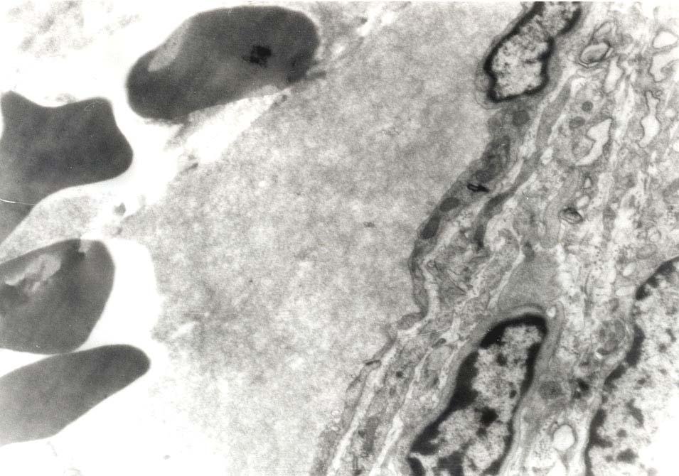 Εικόνα 47. Ομάδα 8: Ενδοθηλιακά κύτταρα με αλλοιώσεις στον πυρήνα.