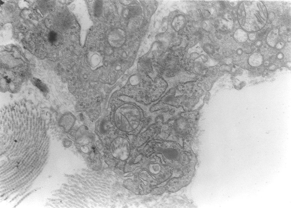 και εκφυλισμένα ινοκύτταρα (Αρχική μεγέθυνση Χ6000). Εικόνα 62.