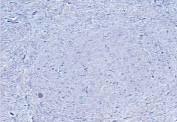 Transmissible Spongiform Encephalopathies (TSEs) Λοιμώδεις θανατηφόρες νευροεκφυλιστικές