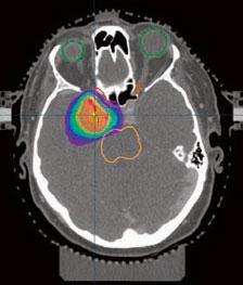 Εικόνα 1 Ακτινοβόληση όγκου εγκεφάλου με την τεχνική VMAT η οποία προσαρμόζει απόλυτα την κατανομή της δόσης στο σχήμα του όγκου στόχου προφυλάσσοντας ταυτόχρονα τα κοντινά όργανα Απαραίτητη