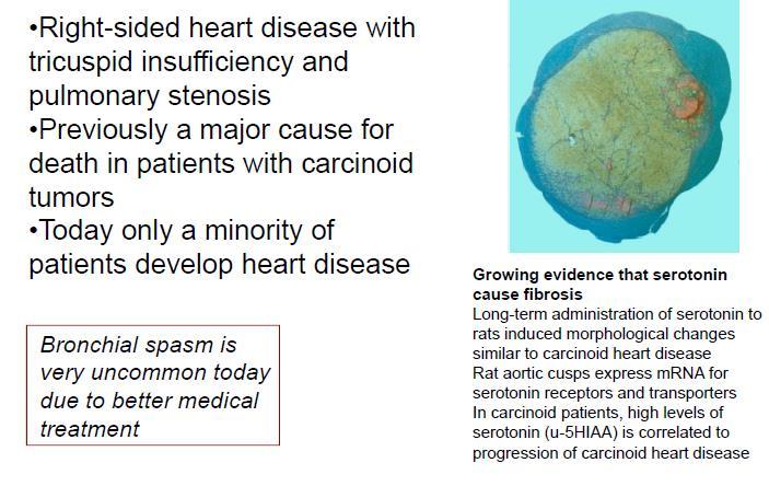 Carcinoid