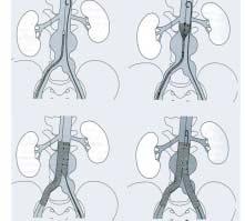 Σχηµατική απεικόνιση τοποθέτησης ενιαίου διχαλωτού αoρτολαγόνιου ενδοµοσχεύµατος. Γ Β 1. Oι ασθενείς υψηλoύ εγχειρητικoύ κινδύνoυ (>5%) για την κλασική ανoικτή χειρoυργική θεραπεία. 2.