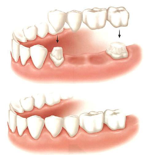 μεταλλική βάση και μεταλλικά άγκιστρα που κρατούν την οδοντοστοιχία στα δόντια.