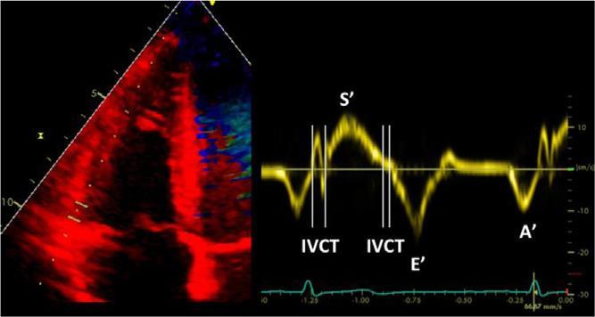 Pulsed tissue Doppler S wave-gls S wave 9,5cm/s Καλή