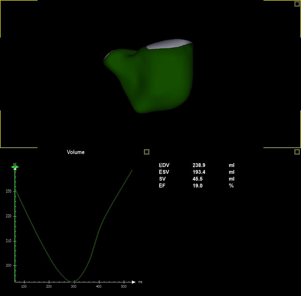 3D ΟΓΚΟΙ-ΚΕ ΔΚ NORMAL RV RV IN PH RV EDV indexed to BSA (ml/m²) Men