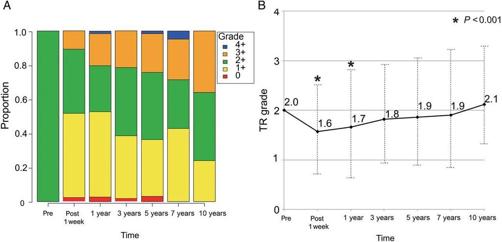 The proportion of tricuspid regurgitation (TR) grade at different points relative to operation (n=885) 36% Kunio Kusajima et al.