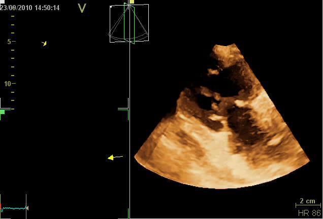 Carcinoid Echo Lab 2nd Cardiology