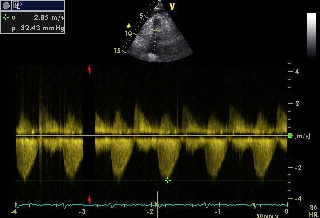 Tricuspid and