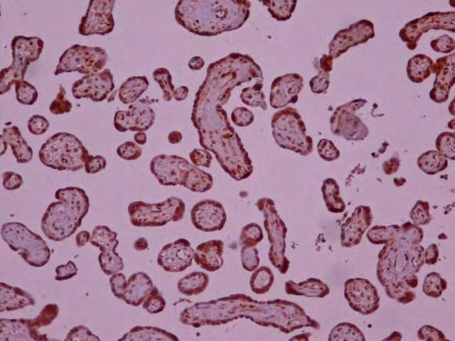 Εικόνα B.2. Μετρίου βαθμού χρώση του HIF-1α. Ανοσοϊστοχημική μελέτη του HIF-1α σε κυτταροτροφοβλάστη από πλακούντα γυναίκας με ετερόζυγη β- θαλασσαιμία.