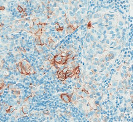 (n = 77) 35% 1% Pancreatic cancer (n = 83) 12% 4% UBC IHC (ICs) UBC IHC (TCs) ICs; tumor-infiltrating immune