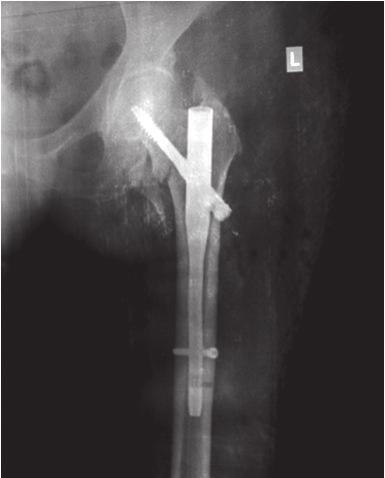 1 Usually, there is pain over the groin on weight bearing correlated with radiographic findings: subchondral fracture, segmental or total collapse of the femoral head accompanied by secondary