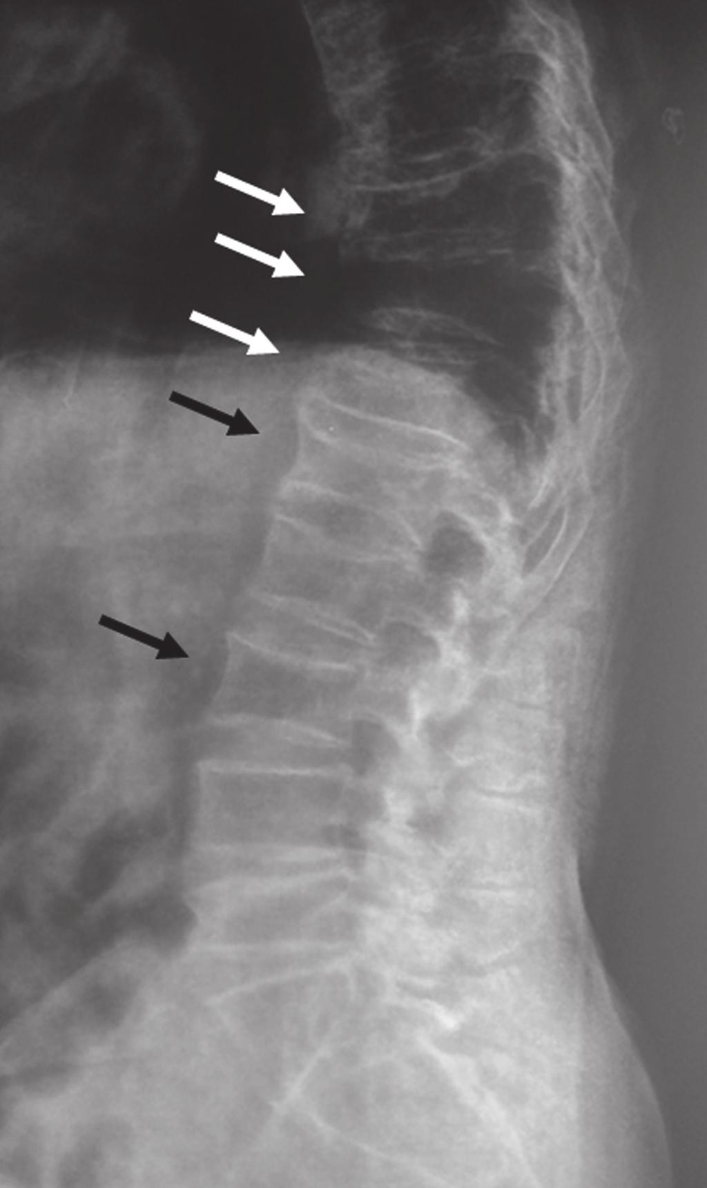 Prevalence of osteoporotic vertebral fractures in patients presenting with osteoporotic hip fractures 109 for a subsequent VF or a fracture in other skeletal sites.
