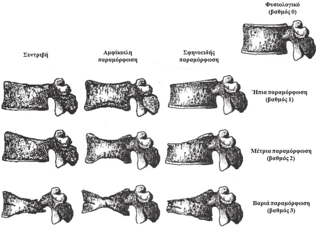 Prevalence of osteoporotic vertebral fractures in patients presenting with osteoporotic hip fractures 111 Figure 2.