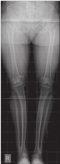 Lower limbs are disproportionately short and present a complex 3-D deformity, consisting of tibial varus, tibial intorsion and genu recurvatum.