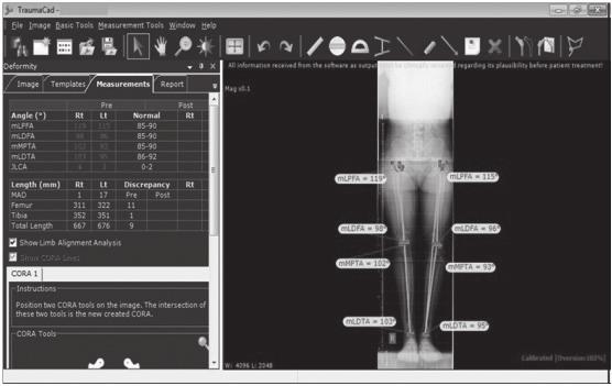 Long term results in achondroplastic patients who have undergone lower limb lengthening using the Ilizarov frame 117 Table 3 Absolute Values and Percentages of Tibial and Femoral Lengthening Mean ±